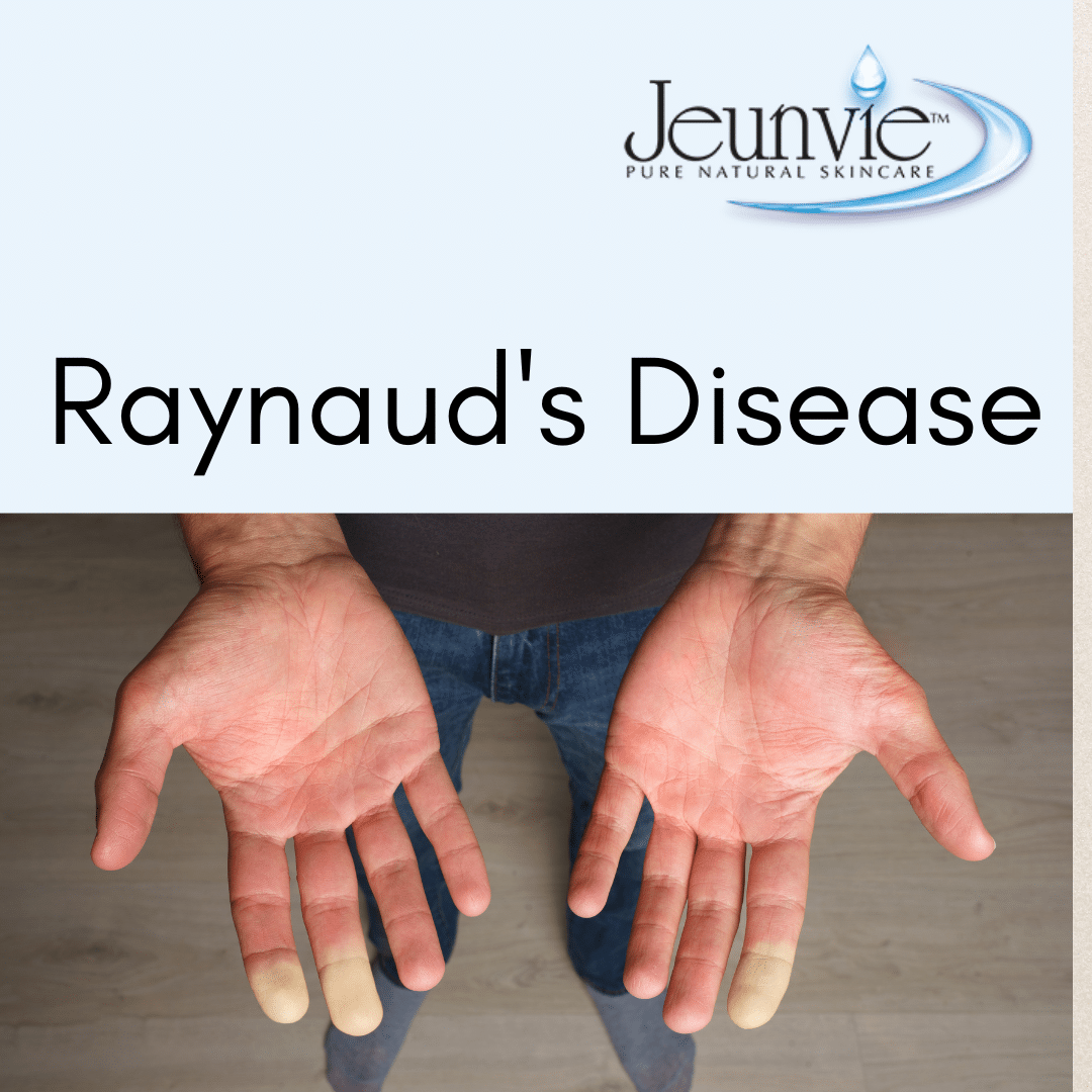 Raynaud's Disease